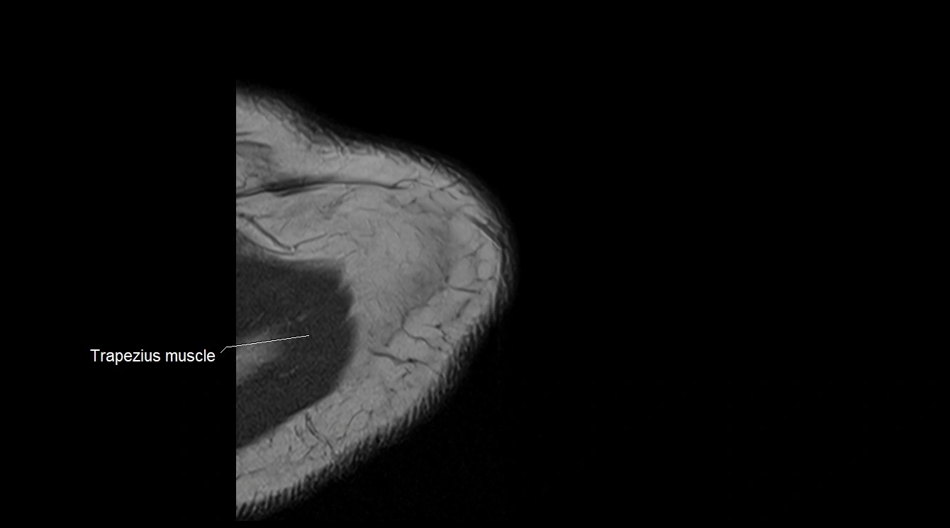 Upper arm( humerus) cross section anatomy MRI 3T axial image 3.webp